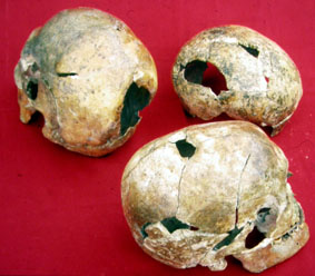 Operated-on skulls found at Ikiztepe. c. Onder Bilgi