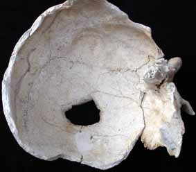 Operated-on skull found at Ikiztepe. c. Onder Bilgi
