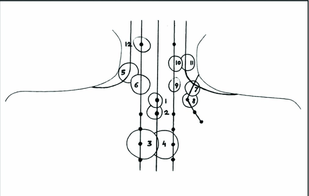 Acupuncture points and meridians passing the zone of the circular tattoos in the neck region of the mummy